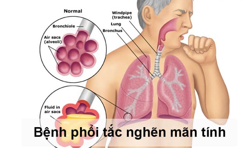 Tất tần tật về phổi tắc nghẽn mạn tính COPD