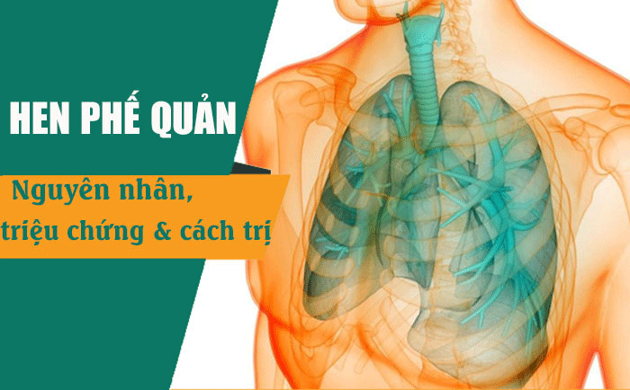 Hen phế quản: Những điều cần biết để sống chung với bệnh