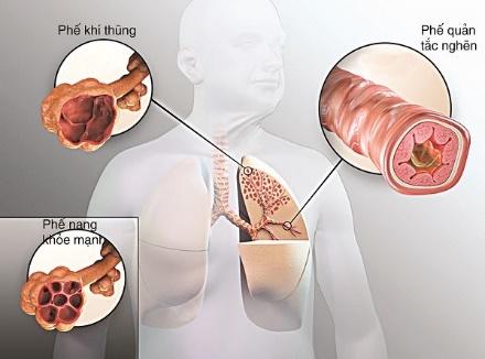 Viêm phế quản mãn tính, phổi tắc nghẽn mãn tính và khí phế thũng 1