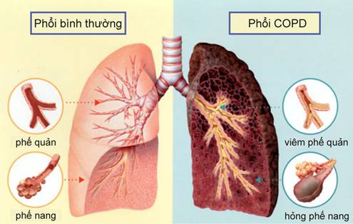 Phân biệt hen phế quản và COPD: Đừng nhầm lẫn kẻ thù