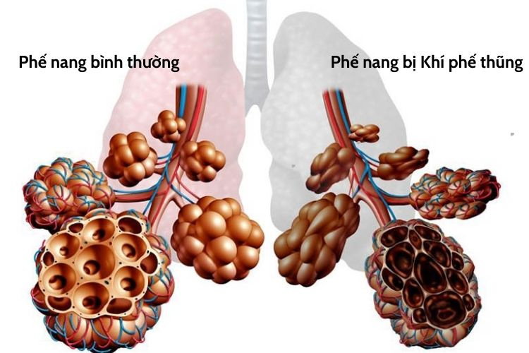 khi-phe-thung.jpg