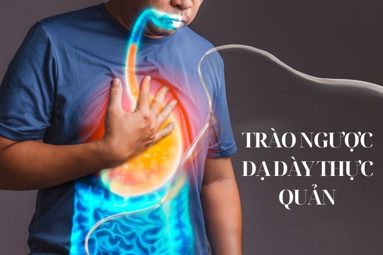 Trào ngược dạ dày-thực quản